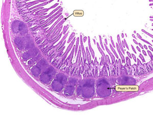 peyers-patches2 - IgA Nephropathy